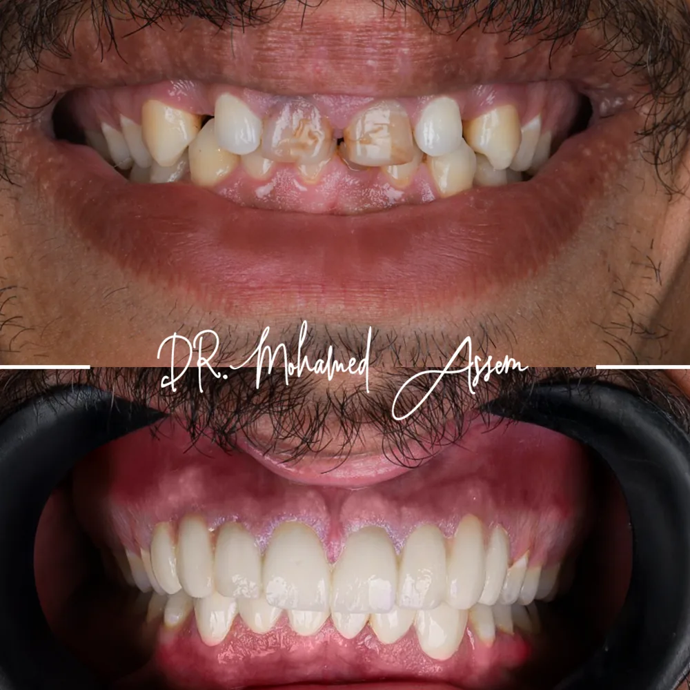 Before and after dental result
