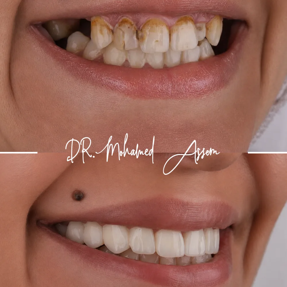 Before and after dental result