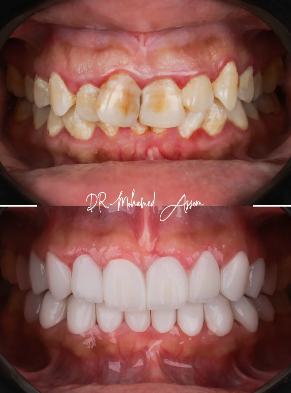 Before and after dental result